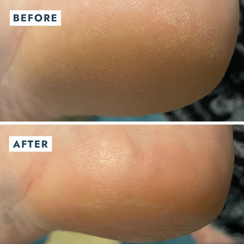 VOESH - HEEL REPAIR DUO (HEEL REPAIR BALM + HEEL SOCKS)